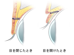 6点固定法断面図