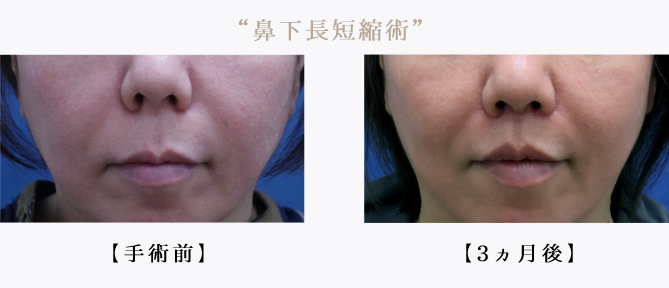 鼻下短縮669.jpg