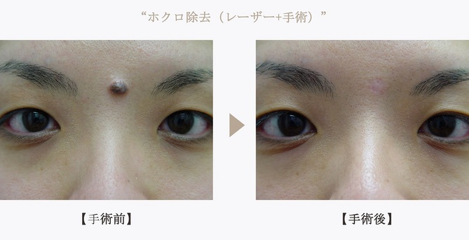 14112901_術前術後.jpg