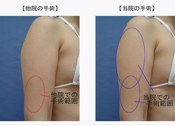 上腕脂肪吸引の修正手術